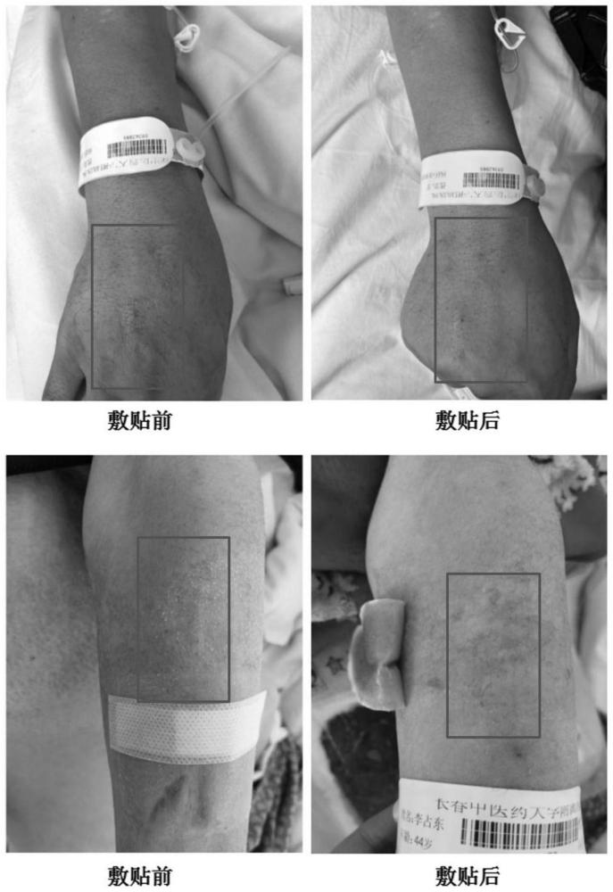 一种治疗静脉炎的中药复方及其制备方法与应用